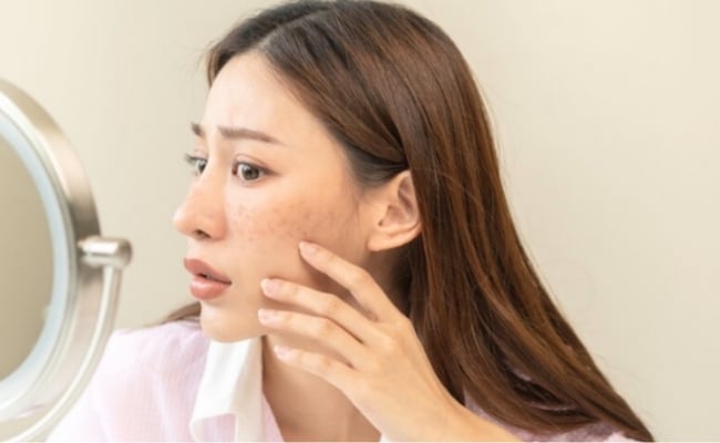 Nám mảng khiến nhiều người cảm thấy tự ti, e ngại trong giao tiếp và ảnh hưởng đến chất lượng cuộc sống