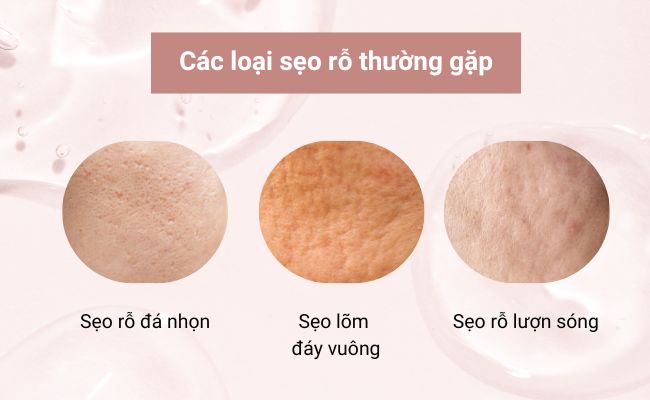 Sẹo rỗ có nhiều loại, phổ biến nhất là sẹo chân đá nhọn, sẹo hình hộp và sẹo lượn sóng.
