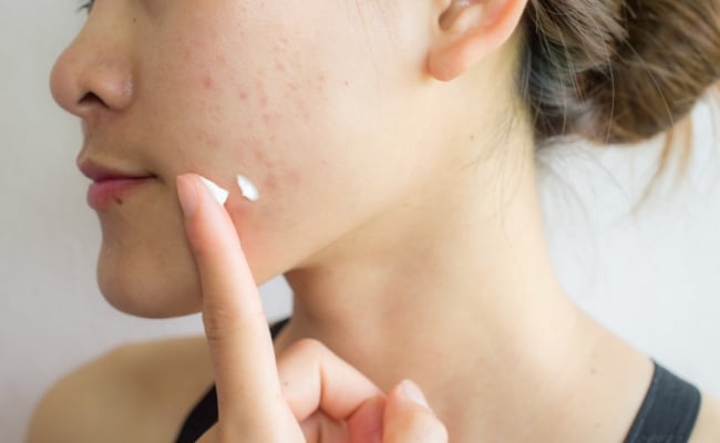 Azelaic Acid có tác dụng gì