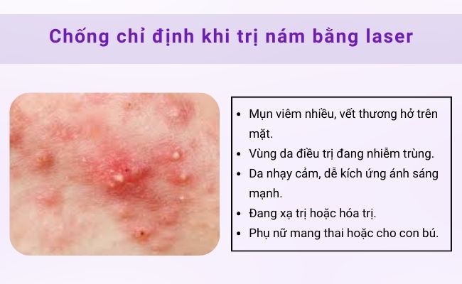 Da nhiều mụn viêm không nên trị nám bằng laser