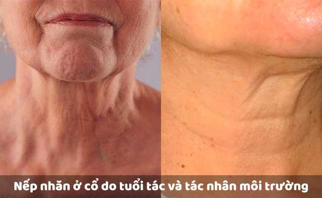 Nguyên nhân gây nếp nhăn ở cổ
