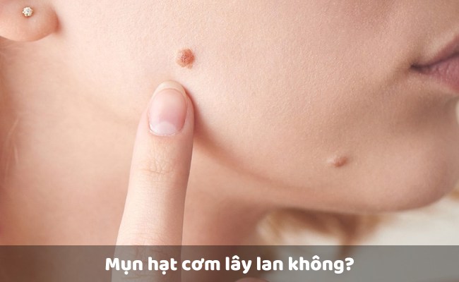Mụn hạt cơm ở mặt có lây lan không?

