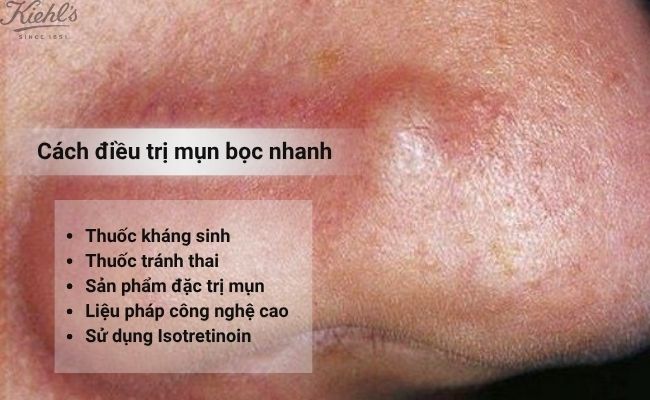 Cách điều trị mụn bọc nhanh
