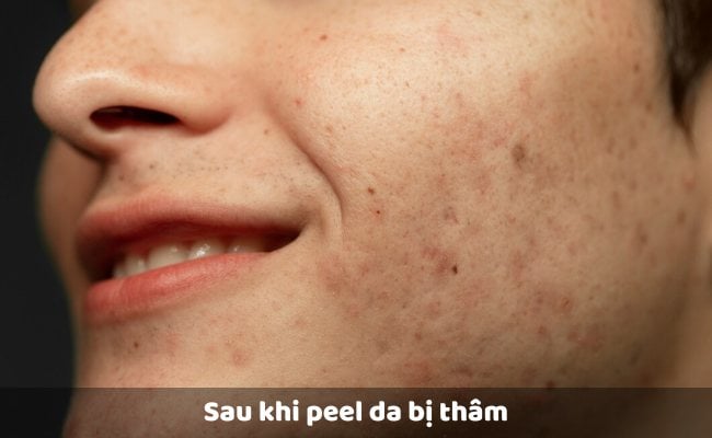Sau khi peel da bị thâm

