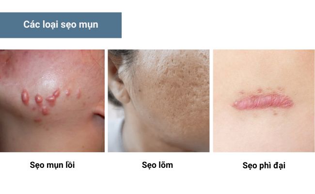 Các loại sẹo mụn