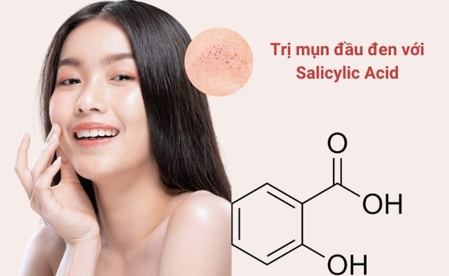Trị mụn đầu đen với Salicylic Acid