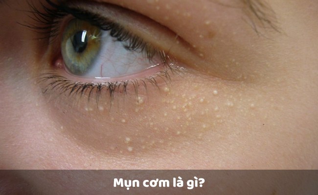 Mụn cơm là gì?