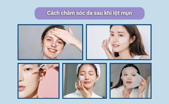Cách chăm sóc da sau khi lột mụn