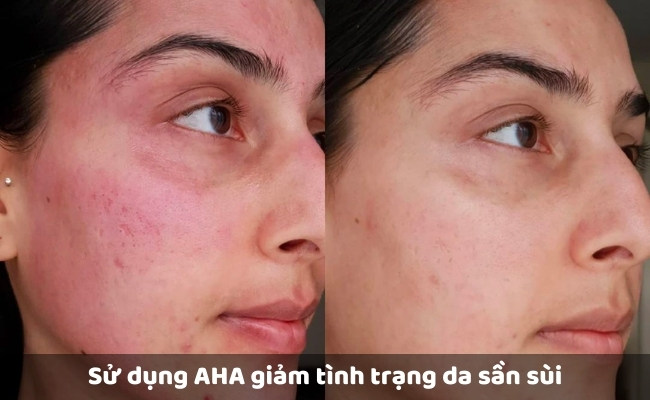 Sử dụng thuốc kháng sinh