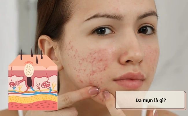 Da mụn là gì?