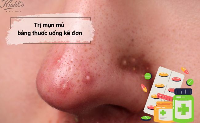 Cách trị mụn mủ sưng to bằng thuốc uống kê đơn