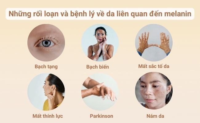 Những bệnh lý về da liên quan đến sắc tố melanin