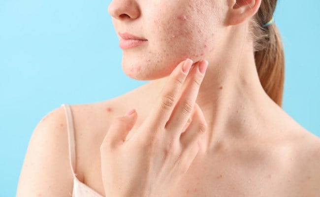 Mặt nổi mụn lấm tấm do dị ứng