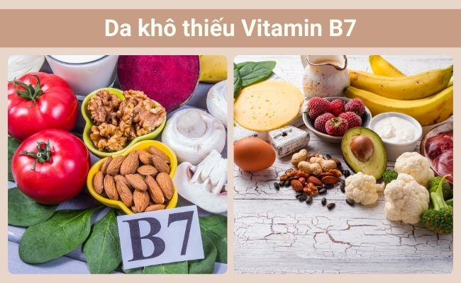 Da khô do thiếu Vitamin 7