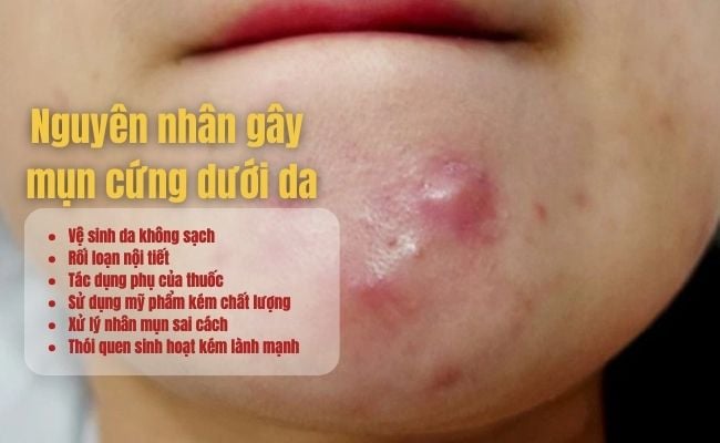 Nguyên nhân gây ra mụn cứng dưới da