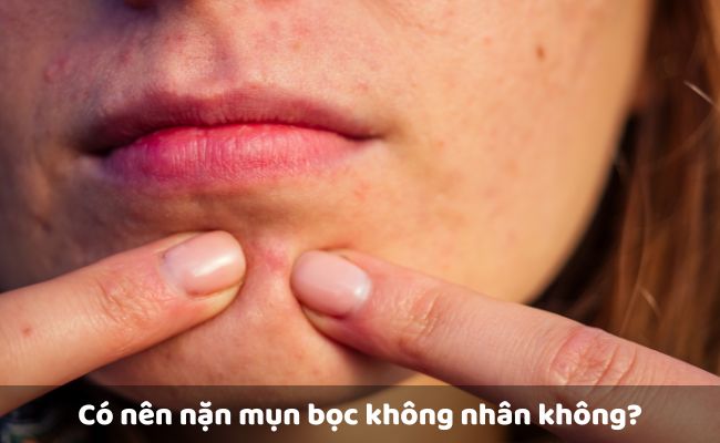 Có nên nặn mụn bọc không đầu không?