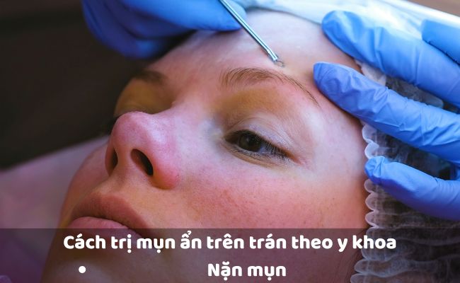 Nặn mụn ẩn trên trán chuẩn y khoa