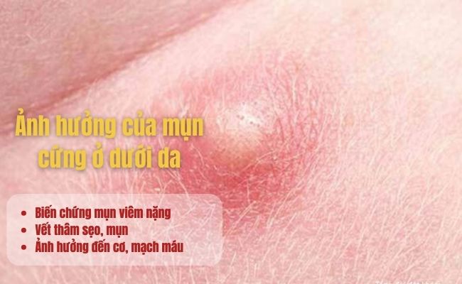 Ảnh hưởng của mụn cứng ở dưới da