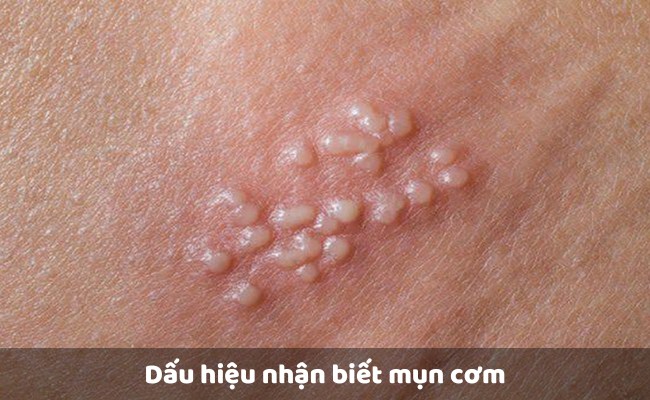 Dấu hiệu nhận biết mụn cơm