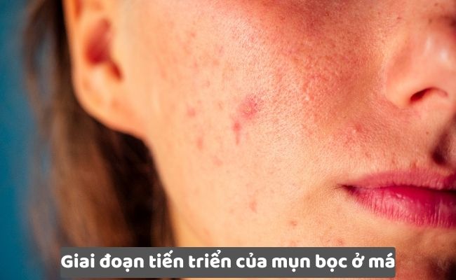 Giai đoạn tiến triển của mụn bọc ở má