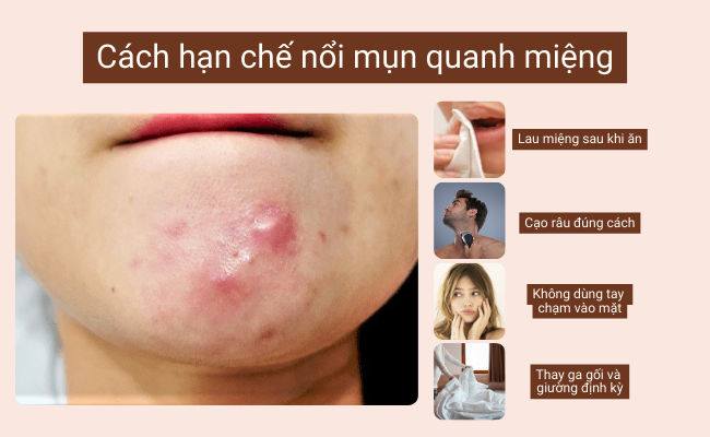 Cách hạn chế nổi mụn quanh miệng