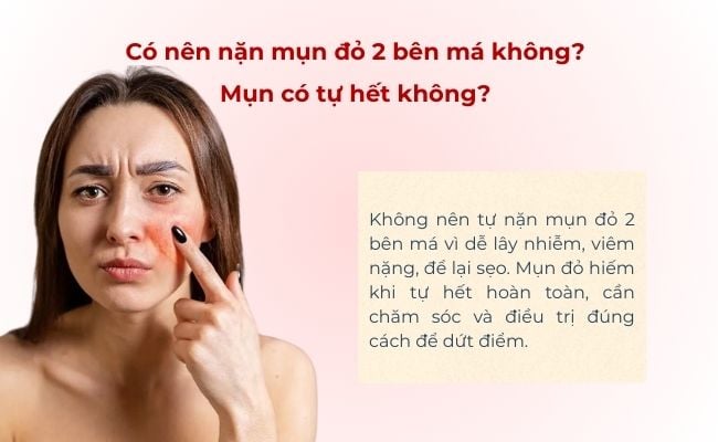 Có nên nặn mụn đỏ 2 bên má không?
