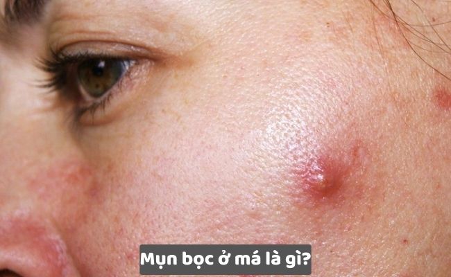 Mụn bọc ở má là gì?