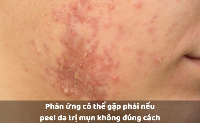 Phản ứng có thể gặp phải nếu peel da trị mụn không đúng cách