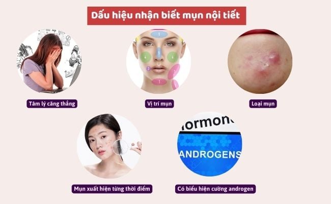 Dấu hiệu nhận biết mụn nội tiết
