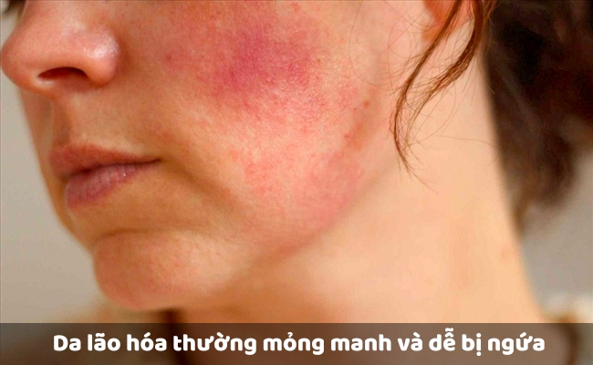  Da lão hóa thường mỏng manh và dễ bị ngứa