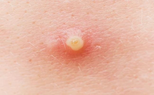 Dấu hiệu nhận biết mụn bọc ở cằm là gì?