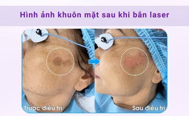 Hình ảnh trước và sau khi điều trị nám bằng laser