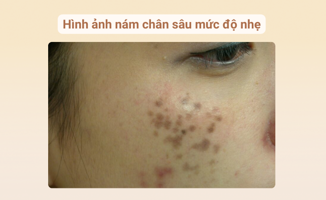 Hình ảnh nám chân sâu mức độ nhẹ