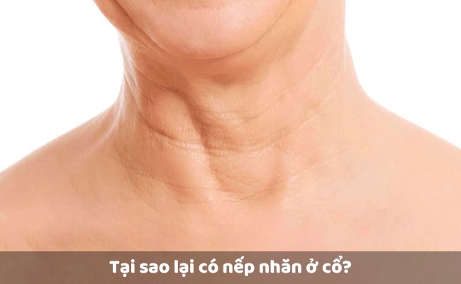 Tại sao lại có nếp nhăn ở cổ?
