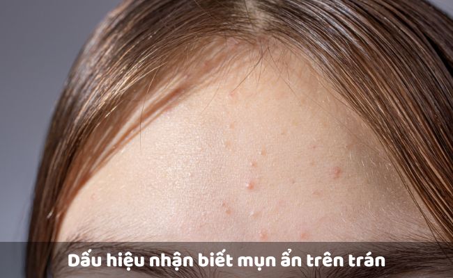 Dấu hiệu nhận biết mụn ẩn trên trán
