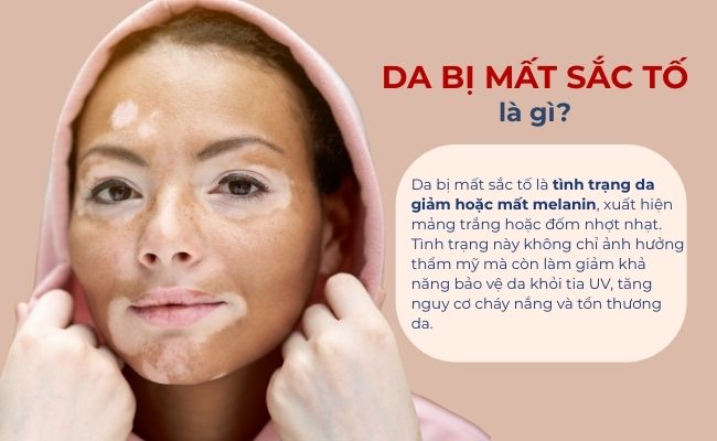 Da mất sắc tố là tình trạng bề mặt da bị suy giảm hoặc mất tạm thời sắc tố