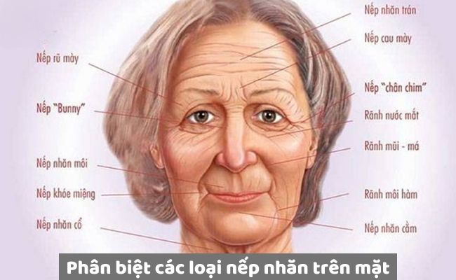 Phân biệt các loại nếp nhăn trên mặt