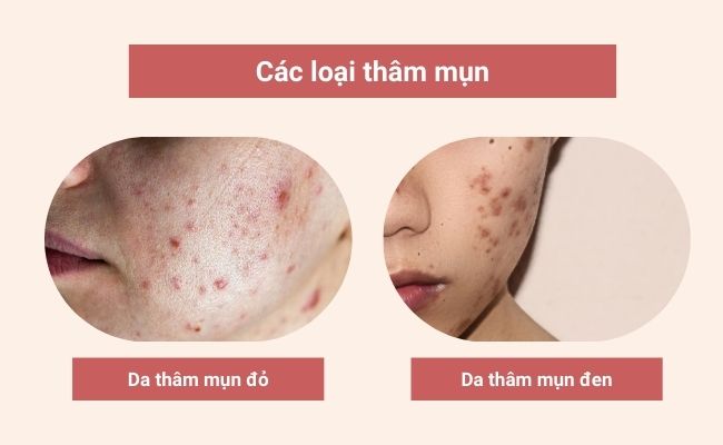 Thâm mụn là gì?