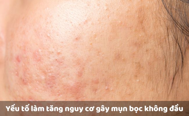 Yếu tố làm tăng nguy cơ gây mụn bọc không đầu