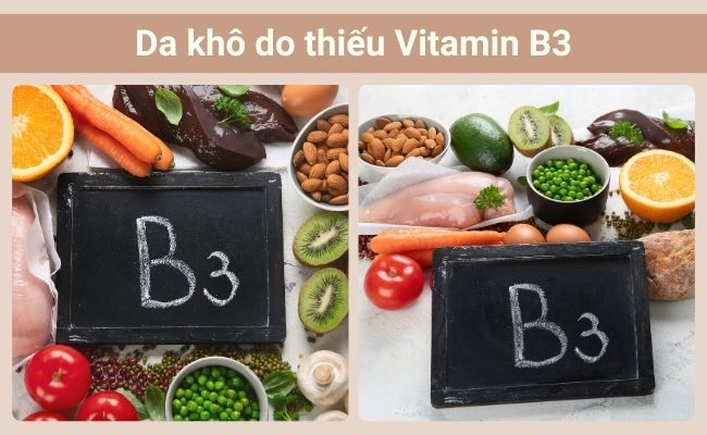 Da khô do thiếu Vitamin B3