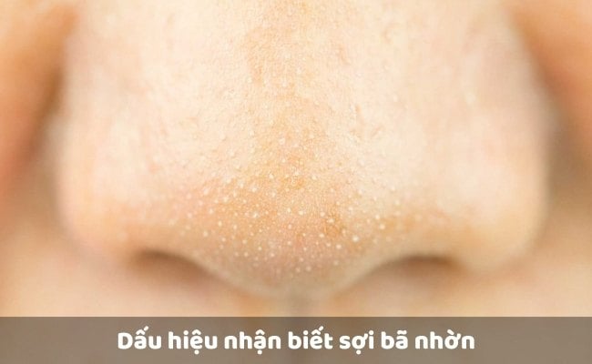 Dấu hiệu nhận biết sợi bã nhờn