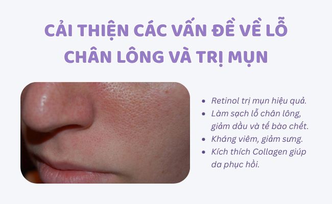 Retinol giúp cải thiện các vấn đề về mụn và lỗ chân lông