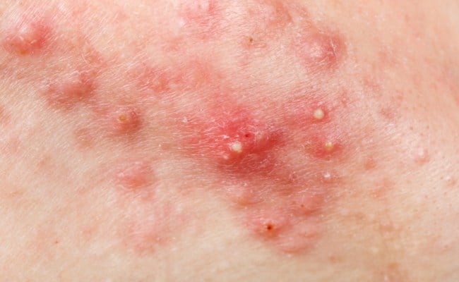 Mụn trứng cá là gì?