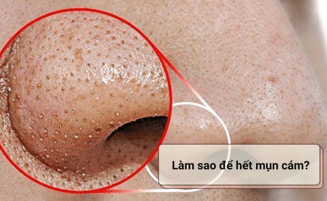 Hướng xử lý mụn cám theo từng tình trạng