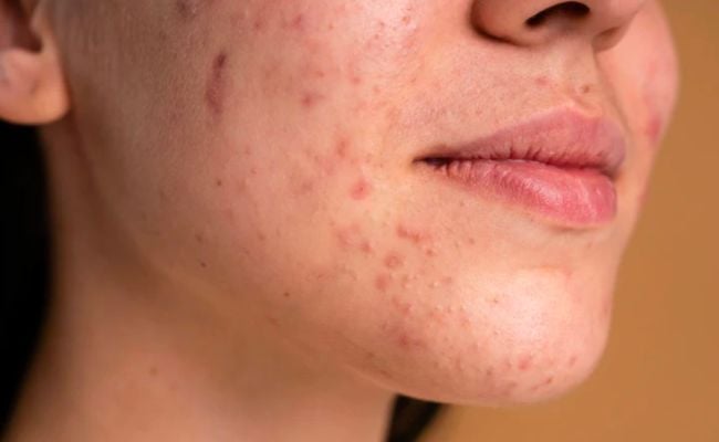 Tăng Sắc Tố Da Sau Viêm Do Đâu Và Cách Điều Trị | Kiehl's
