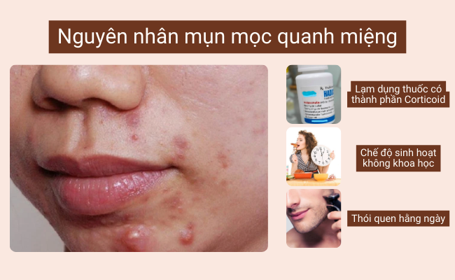Mụn mọc quanh miệng do lạm dụng thuốc, sinh hoạt không khoa học