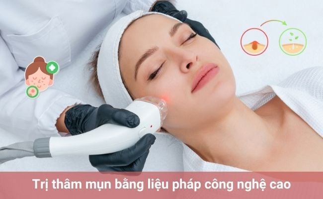 Cách trị thâm mụn bằng liệu pháp thẩm mỹ công nghệ cao