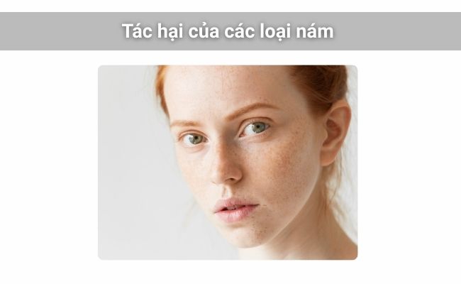 Các loại nám gây ảnh hưởng đến ngoại hình và tâm lý của phái nữ