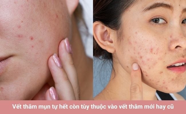 Thâm mụn có tự hết không?