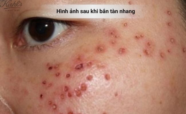 Hình ảnh sau khi bắn tàn nhang